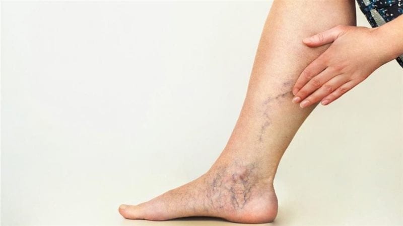 مرض الدوالي