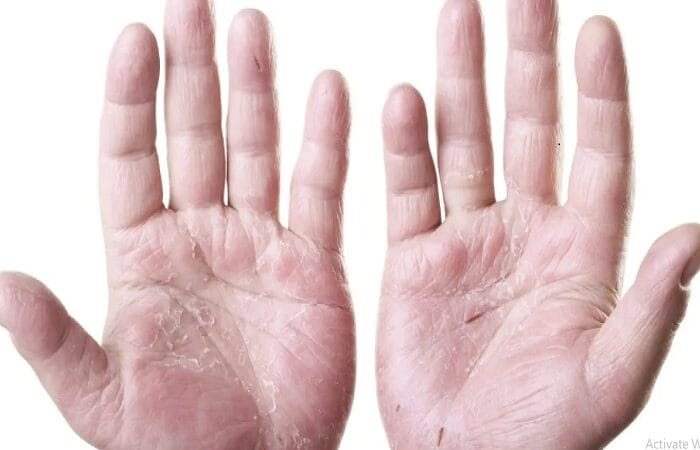 مرض الصدفية - تعبيرية